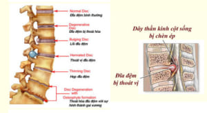 Thoát vị đĩa đệm cột sống cổ