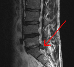 Thoát vị đĩa đệm trên phim MRI