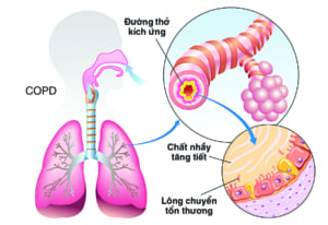 Bệnh phổi tắc nghẽn mạn tính