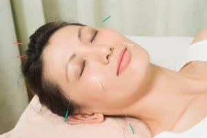 Châm cứu điều trị viêm mũi xoang