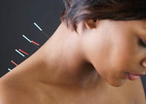 Châm cứu chữa vẹo cổ cấp tính