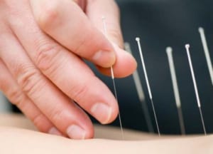 Châm cứu điều trị mất tiếng