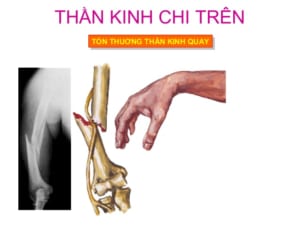 Tổn thương thần kinh quay