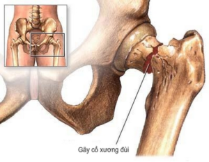 gãy cổ xương đùi