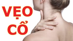 Vẹo cổ cấp