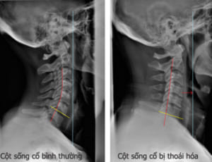 X-Quang thoái hóa cột sống cổ