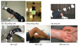 Vật lí trị liệu sau phẫu thuật thay khớp gối