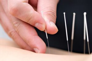 Hình ảnh châm cứu điều trị mất tiếng