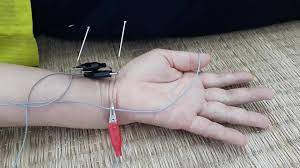 châm cứu điều trị hội chứng ống cổ tay