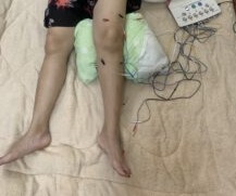 Châm cứu điều trị thoái hóa khớp gối