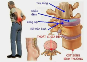 Thoát vị đĩa đệm
