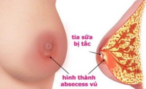 Biến chứng tắc tia sữa